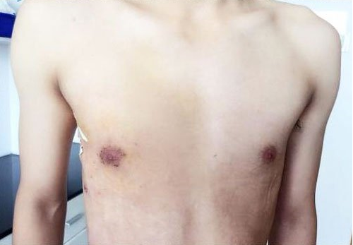 Doctors Suspect Male Teen's A Cup Right Breast Caused By Excessive Fast Food - World Of Buzz 1