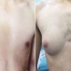 Doctors Suspect Male Teen'S A Cup Right Breast Caused By Excessive Fast Food - World Of Buzz 4