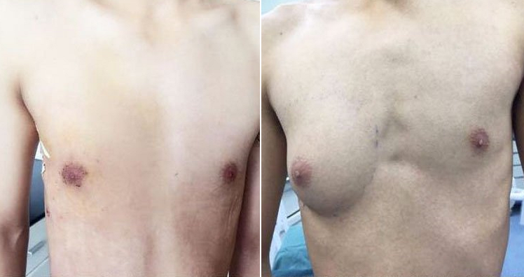 Man grew single A-cup boob and doctors think fast food may be to