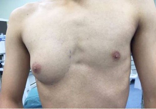 Doctors Suspect Male Teen's A Cup Right Breast Caused By Excessive Fast Food - World Of Buzz