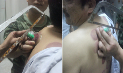 Firefighters Saw Off Cup Stuck To Man'S Back Due To Home Cupping Therapy - World Of Buzz 3