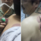 Firefighters Saw Off Cup Stuck To Man'S Back Due To Home Cupping Therapy - World Of Buzz 3