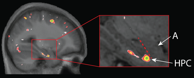 hippocampal atrophy in video game players