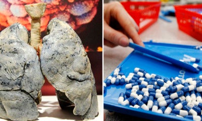 Man'S Lungs Turn Into Cotton-Like After Excessive Consumption Of Antibiotics - World Of Buzz