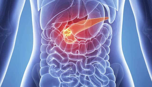 pancreatic cancer1