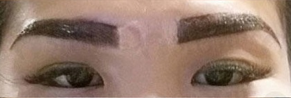 Singapore Lady Goes for Eyebrow Embroidery, Gets Scars from Procedure - World Of Buzz 5