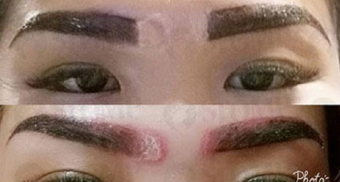 Singapore Lady Goes For Eyebrow Embroidery, Gets Scars From Procedure - World Of Buzz 8