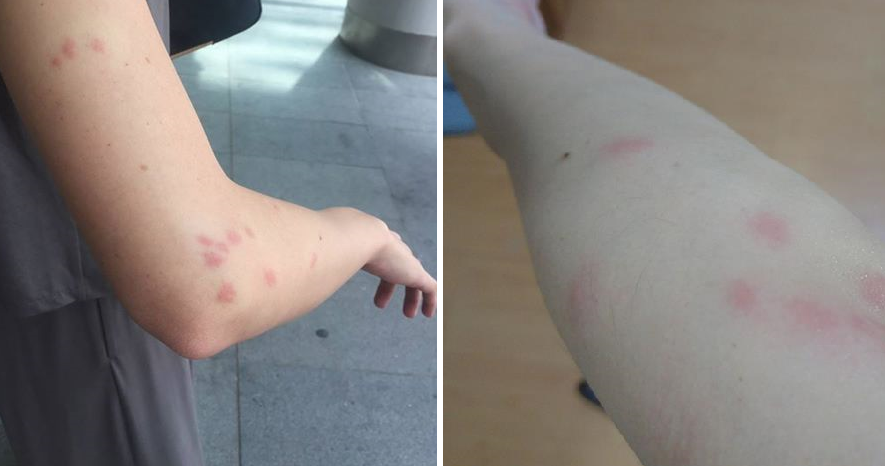 Woman Allegedly Got Bed Bug Bites From S'Porean Budget Airline, Demands Explanation - World Of Buzz 3