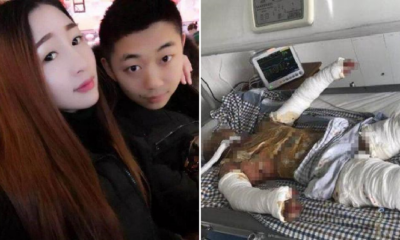 Devoted Gf Shows What True Love Is By Staying By Bf'S Side Despite 90% Burns - World Of Buzz