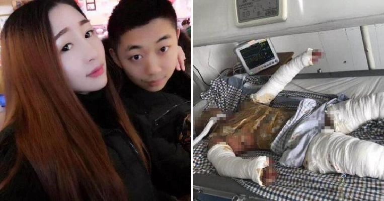 Devoted Gf Shows What True Love Is By Staying By Bf's Side Despite 90% Burns - World Of Buzz