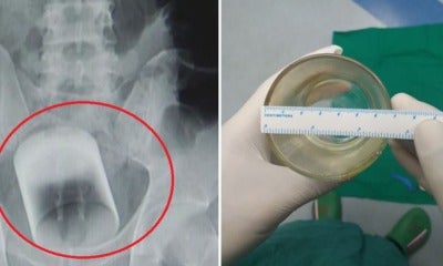 Doctors Find Glass Stuck In Man'S Rectum, He Refuses To Explain How It Happened - World Of Buzz 3