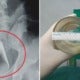Doctors Find Glass Stuck In Man'S Rectum, He Refuses To Explain How It Happened - World Of Buzz 3