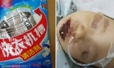 Toddler Sustains Serious Injuries On Mouth And Body After Accidentally Eating Washing Powder - World Of Buzz 2
