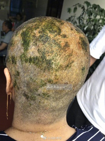Woman Suffers Burns On Scalp And Forced To Go Bald After Dyeing Hair In Salon - World Of Buzz 2