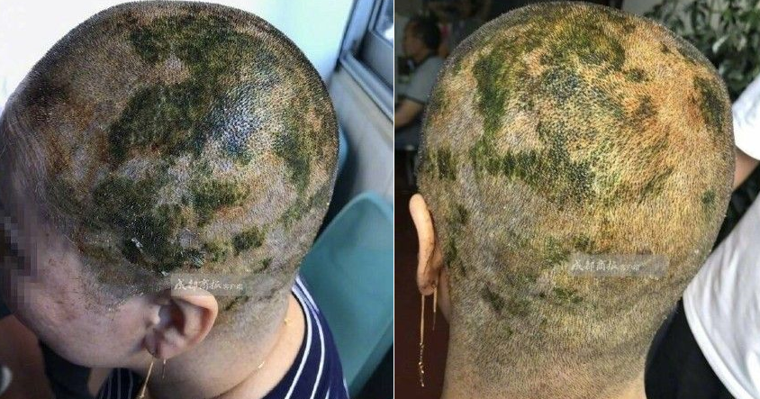 Girl Suffers Chemical Burns On Scalp After Salon Leaves Bleach On