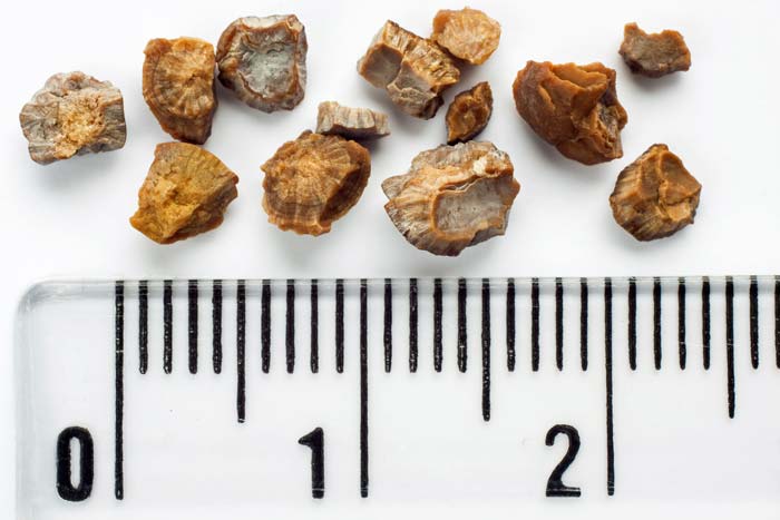 Doctor Removes 9 Kidney Stones From 9Yo Boy, Suspect Milk Powder Is The Cause - World Of Buzz