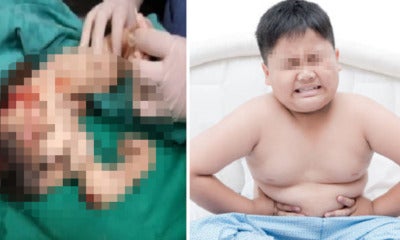 M'Sian Doctors Removed Young Boy'S Unborn Twin In His Body After 15 Years - World Of Buzz 1