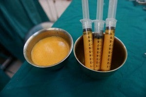 Thai Women are Now Injecting Fat into Their Hoo-Ha to Get a Fuller 3D Vagina - WORLD OF BUZZ 1