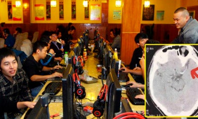 University Student Suffers Stroke In Brain After Gaming For 3 Days Continuously - World Of Buzz