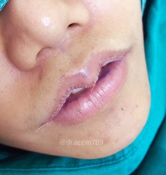 Asian People are Actually Getting Surgery For Lip Reduction - WORLD OF BUZZ 2