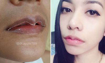 Goodbye Kylie Jenner Lips, Asian People Are Now Getting Lip Reduction Surgeries - World Of Buzz
