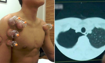 Man With Bronchitis Undergoes Cupping Therapy, Lungs Shockingly Shrunk For 90% - World Of Buzz
