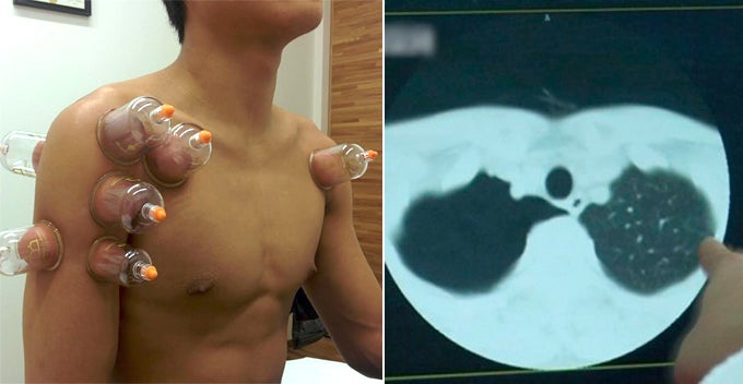 Man With Bronchitis Undergoes Cupping Therapy, Lungs Shockingly Shrunk For 90% - World Of Buzz