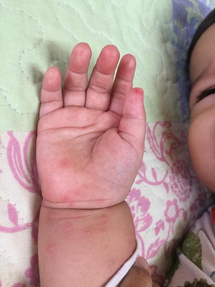 M'sian Child Contracts Hand, Foot and Mouth Disease After Sitting in Baby Chair - WORLD OF BUZZ 4