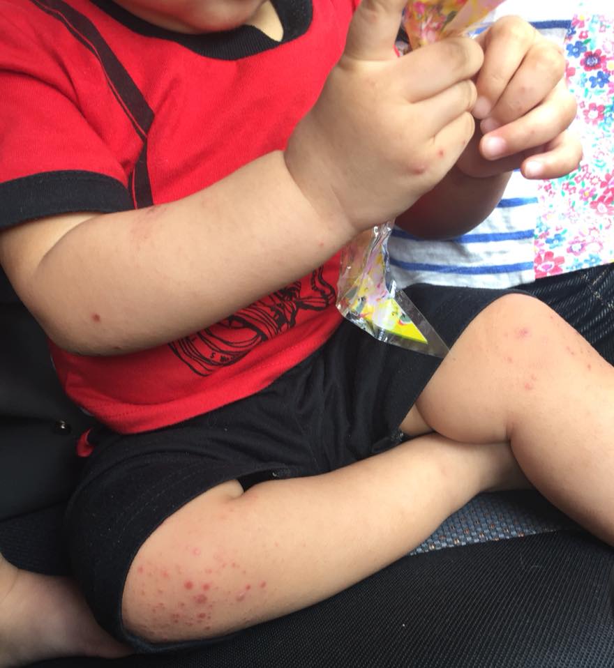 M'sian Child Contracts Hand, Foot and Mouth Disease After Sitting in Baby Chair - WORLD OF BUZZ 7