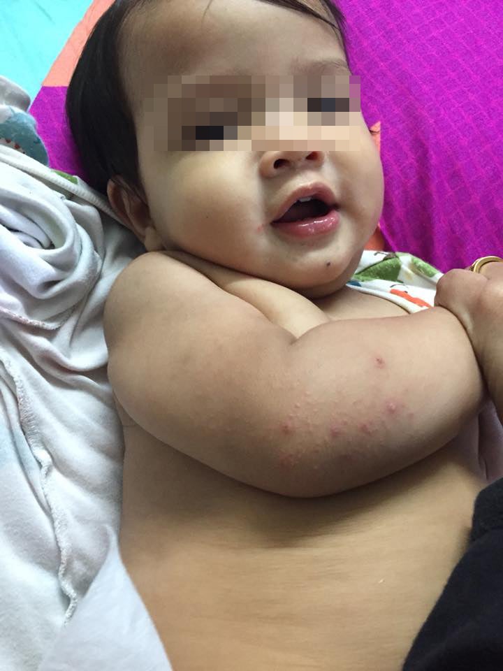 M'sian Mother Shares How Child Contracted Hand, Foot & Mouth Disease From Dirty Chair - WORLD OF BUZZ 2