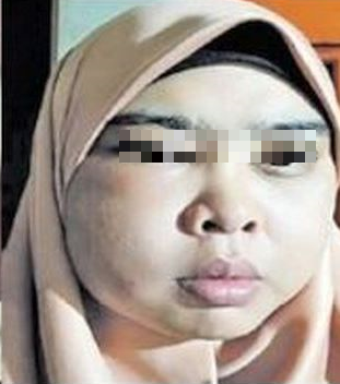 M'sian Woman Suffers From Swollen, Painful Face After Using Online Beauty Product - World Of Buzz 1