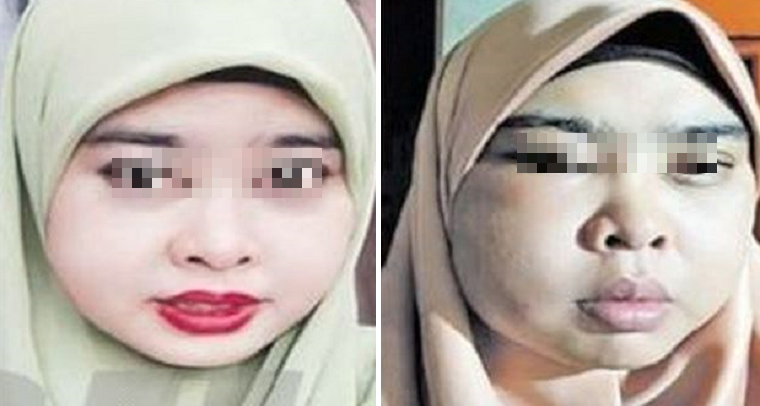 M'Sian Woman Suffers From Swollen, Painful Face After Using Online Beauty Product - World Of Buzz 4