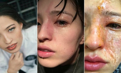 Young Lady Disfigured After Essential Oil Vapour Accidentally Sprayed On Her Face - World Of Buzz