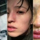 Young Lady Disfigured After Essential Oil Vapour Accidentally Sprayed On Her Face - World Of Buzz