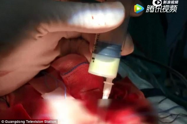 10yo Girl Needed Part of Her Skull Removed After Mother Squeezed Out Her Blackheads with Unclean Hands - WORLD OF BUZZ 3
