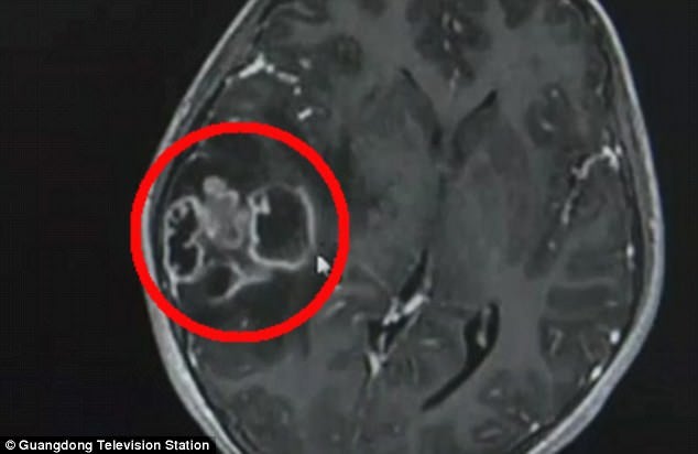 10Yo Girl Needed Part Of Her Skull Removed After Mother Squeezed Out Her Blackheads With Unclean Hands - World Of Buzz 4