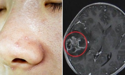 10Yo Girl Needed Part Of Her Skull Removed After Mother Squeezed Out Her Blackheads With Unclean Hands - World Of Buzz 8