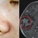 10Yo Girl Needed Part Of Her Skull Removed After Mother Squeezed Out Her Blackheads With Unclean Hands - World Of Buzz 8