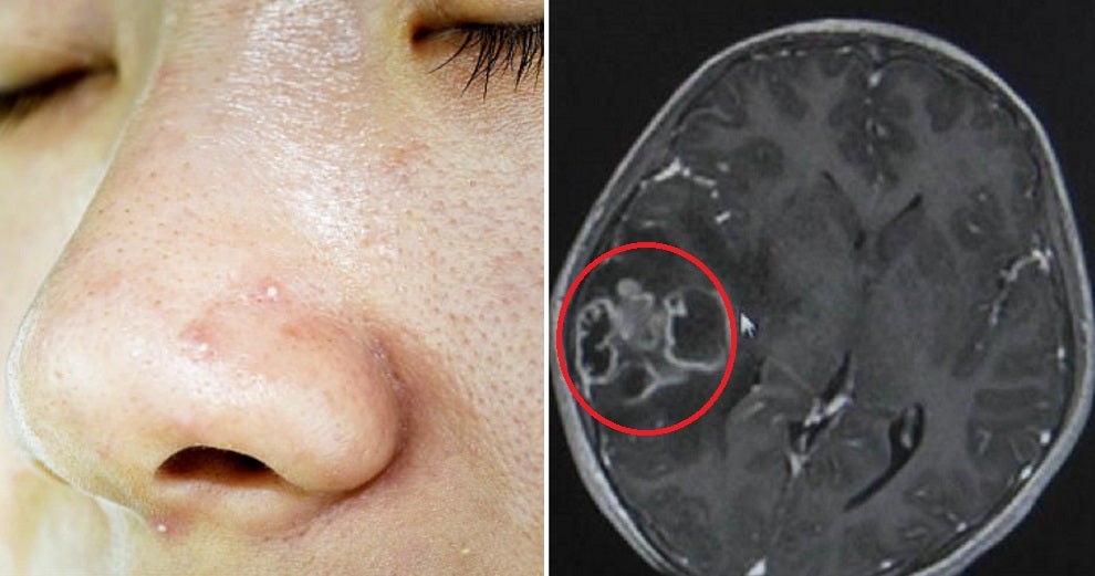 10Yo Girl Needed Part Of Her Skull Removed After Mother Squeezed Out Her Blackheads With Unclean Hands - World Of Buzz 8