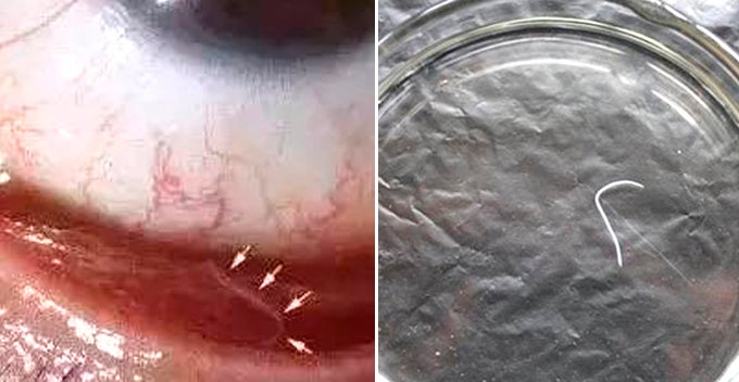 chinese lady loves cuddling with pet dog discovers 2cm worm inside her eye world of buzz