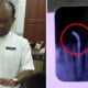 Lady Gets Braces At Ampang Clinic, Ends Up With Horrible Infection And Damaged Roots - World Of Buzz