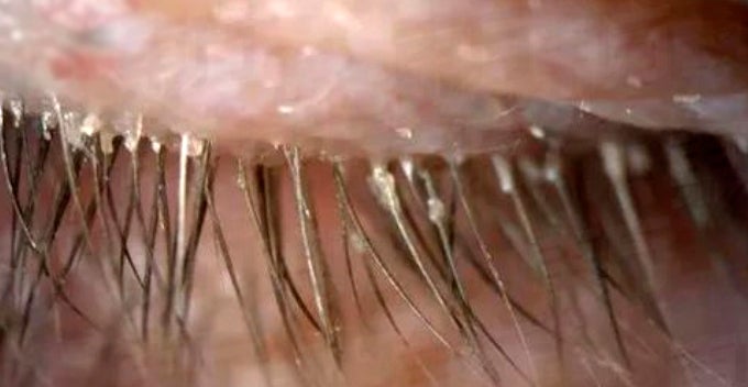 Woman Uses Unwashed Pillow Case For 5 Years, Contracts Over 100 Mites In Her Eyelashes - World Of Buzz