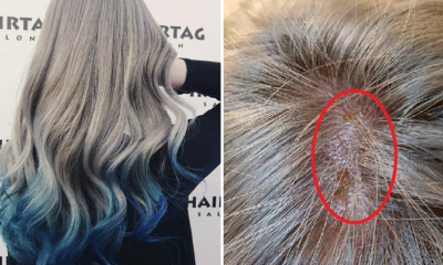 Girl Suffers Chemical Burns On Scalp After Salon Leaves Bleach On For 3 Hours - World Of Buzz 6