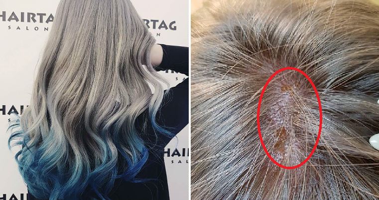 Girl Suffers Chemical Burns On Scalp After Salon Leaves Bleach On
