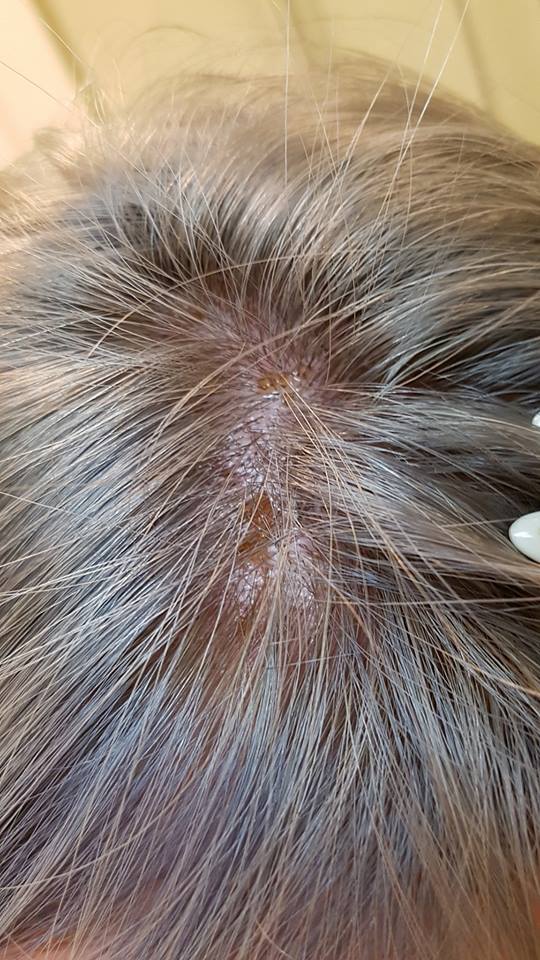 Girl Suffers Chemical Burns on Scalp After Salon Leaves Bleach on for 3 Hours - WORLD OF BUZZ 1