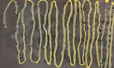 Man Passes Out 2.8M-Long Tapeworm From Rectum, Had Absolutely No Idea It Was Inside - World Of Buzz 2