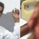 Man Suffers Terrible Burn After Getting Conned By Bogus Private Doctor In Sg. Buloh - World Of Buzz