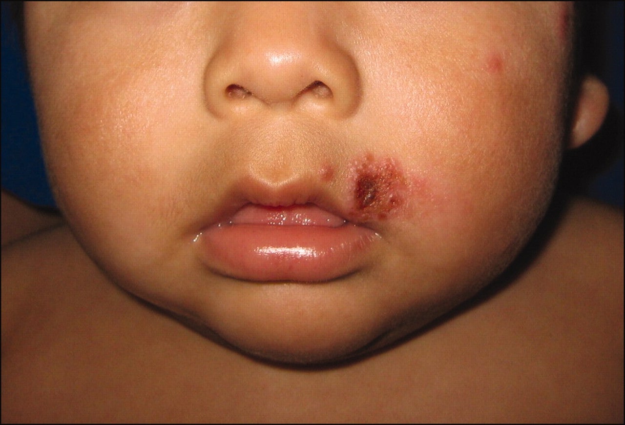 Mother Warns Others Not To Simply Kiss Babies After Son Contracts Terrible Rash - WORLD OF BUZZ 1