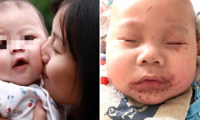 Mother Warns Others Not To Simply Kiss Babies After Son Contracts Terrible Rash - World Of Buzz 2