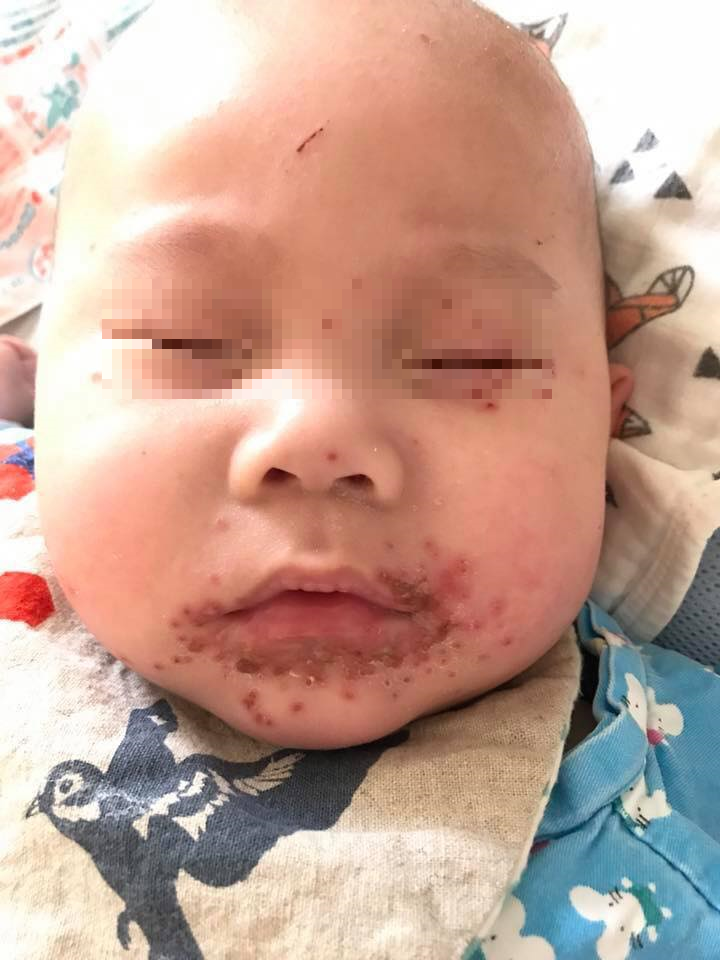 Mother Warns Others Not To Simply Kiss Babies After Son - WORLD OF BUZZ